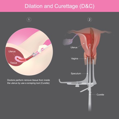 Dilatation & Curettage