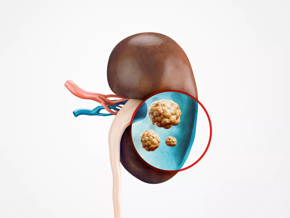 Kidney Stones