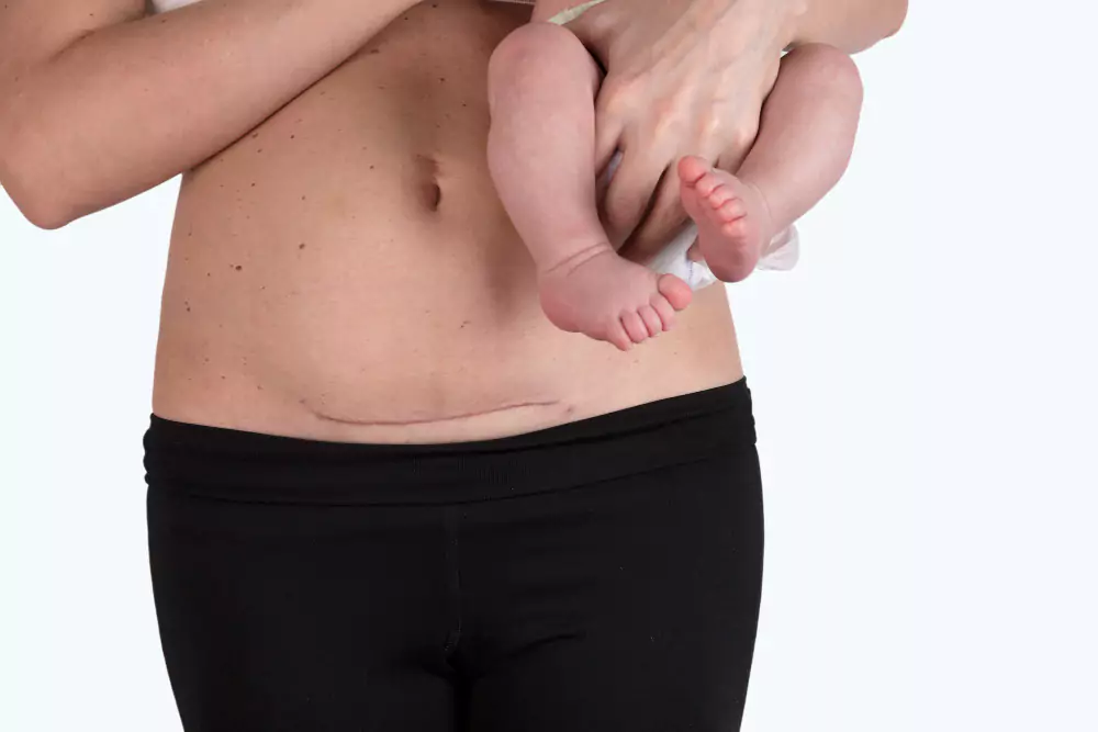 Caesarean Section (LSCS)